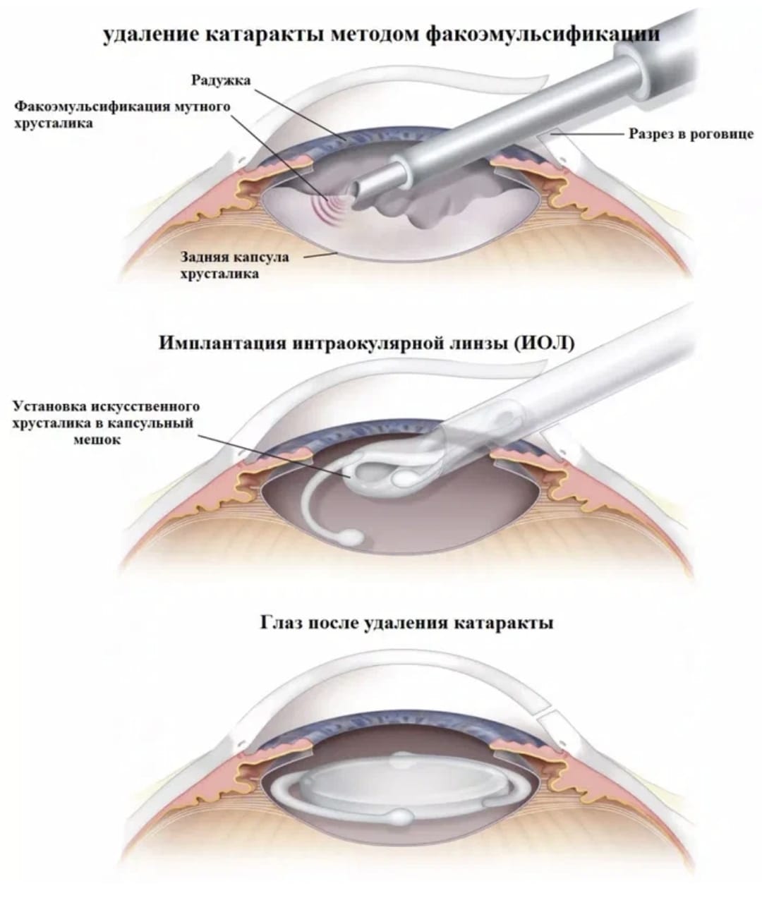 Когда после замены хрусталика восстанавливается зрение глаза. Ультразвуковая факоэмульсификация катаракты этапы. Ультразвуковая факоэмульсификация с имплантацией ИОЛ. Техника факоэмульсификации катаракты с имплантацией ИОЛ. Факоэмульсификация катаракты этапы операции.